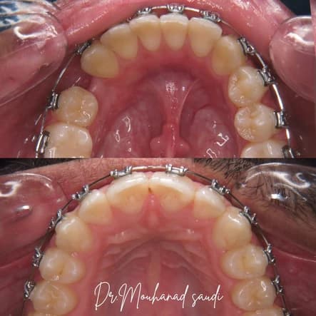 Orthodontics 4